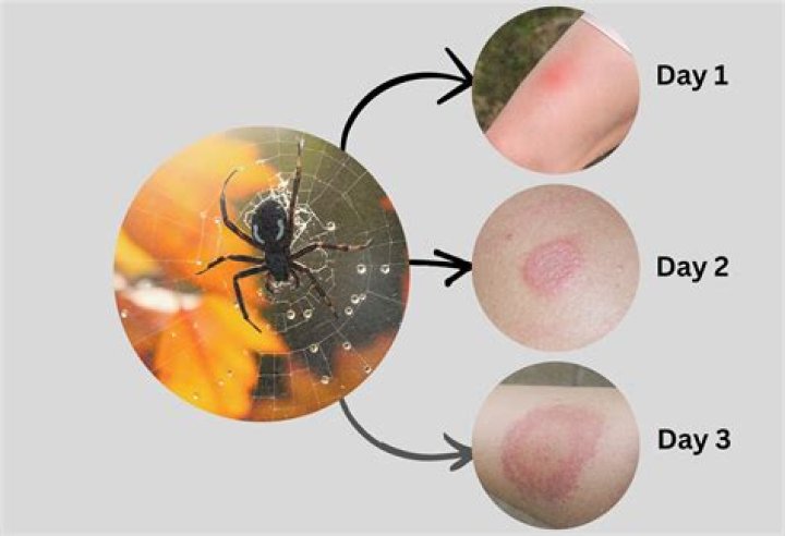 Are poisonous spider bites painful?
