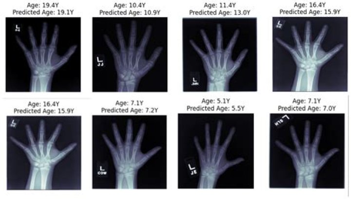 At what age bone growth stops?