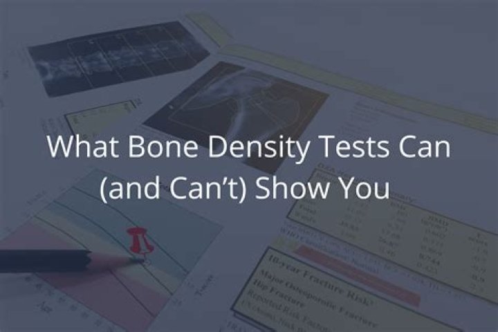 At what age should you stop getting bone density tests?