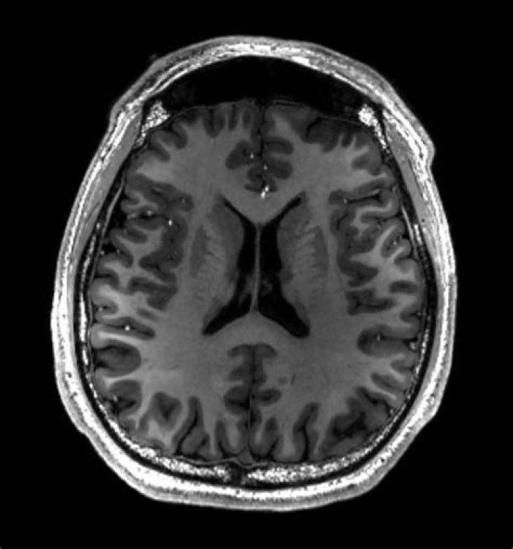 Can a brain MRI show depression?