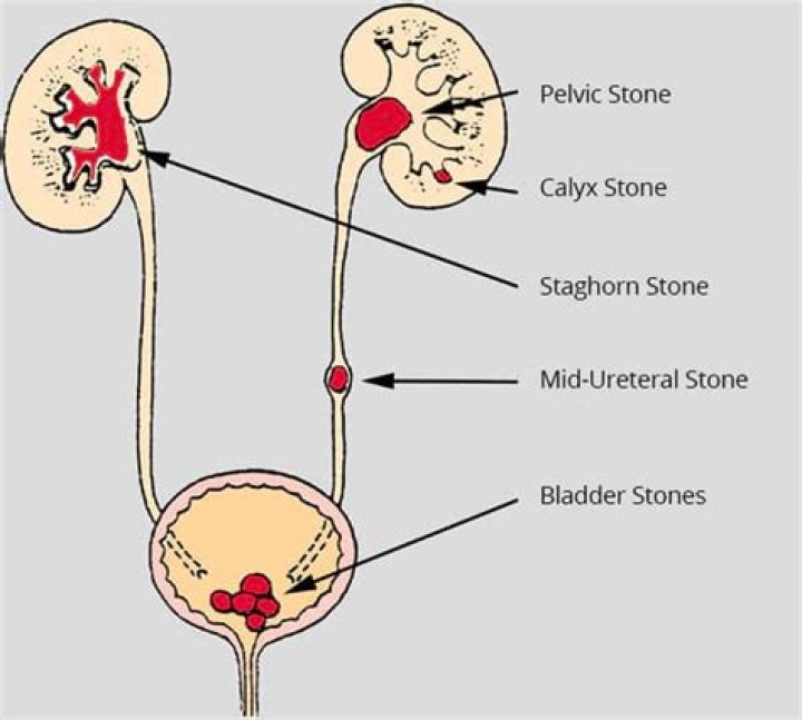 Can a kidney stone get stuck in your pee hole?