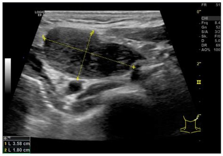 Can an ultrasound tell if a lymph node is cancerous?