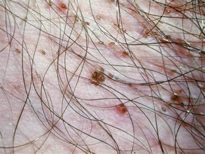 Can head lice live in pubic hair?