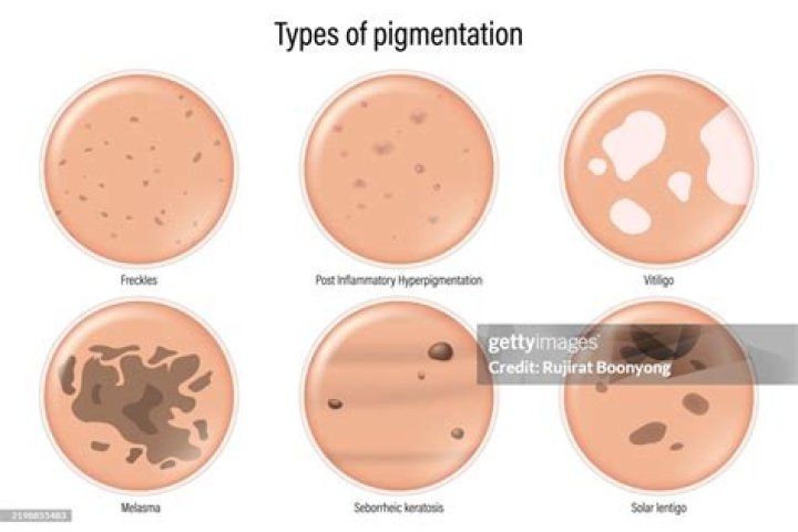 Can hypopigmentation be cured?