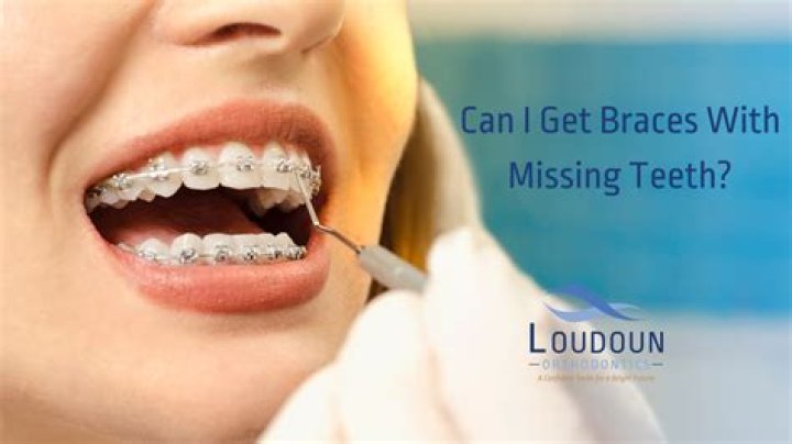 Can I get braces without needing them?
