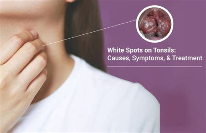 Can white spots on tonsils be viral?