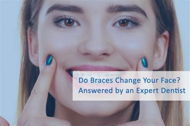 Do braces ever stop cutting your mouth?