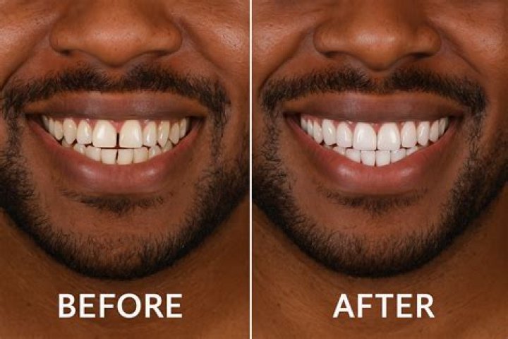 Do veneers go yellow?