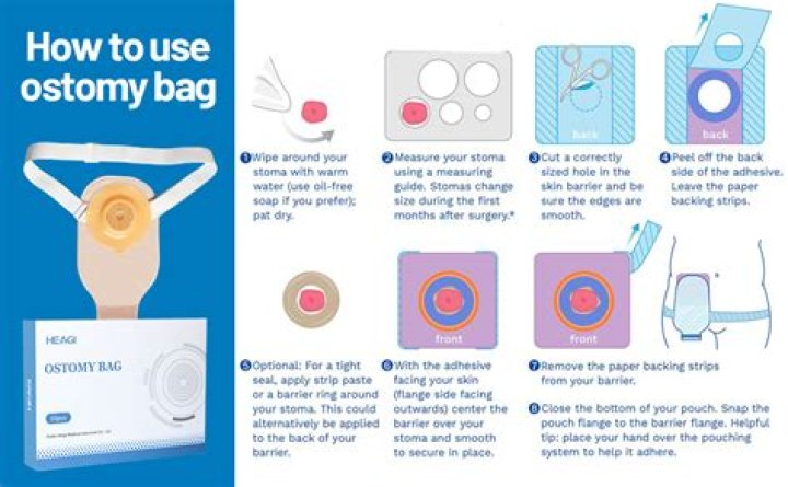 Do you need a colostomy bag with diverticulitis?