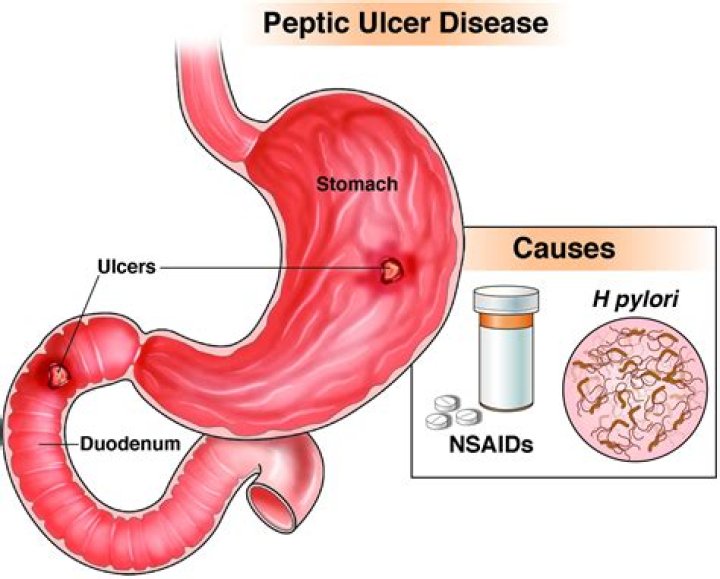 Does aspirin cause stomach bleeding?