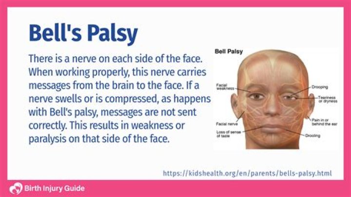 Does Bell's palsy affect your nose?