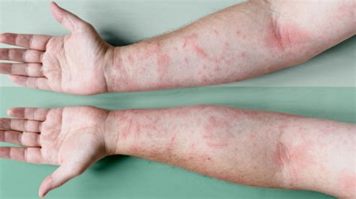 Does biotin help eczema?