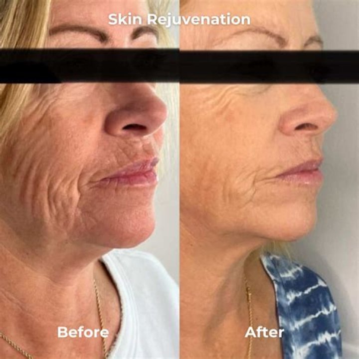 Does microneedling help neck skin?