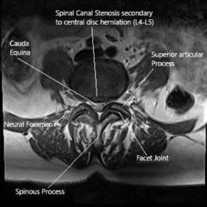 Does sciatica show up on MRI?