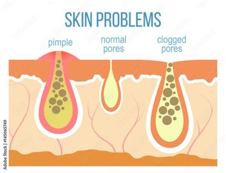 Does steam unclog pores?
