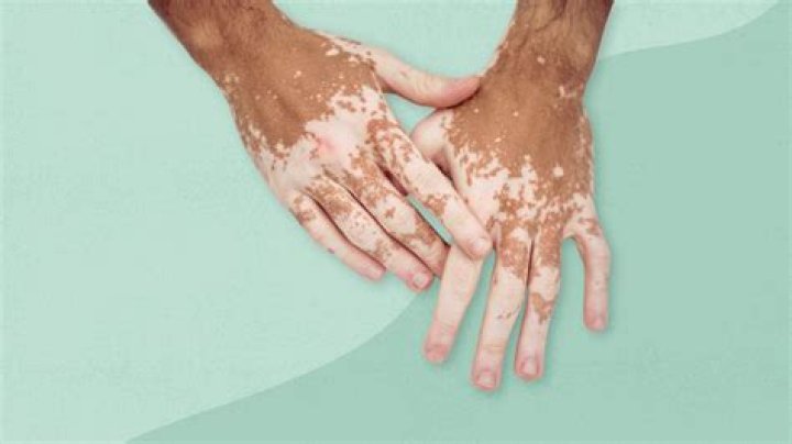 Does sun make vitiligo worse?