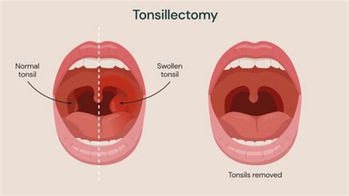 How are tonsils size graded?