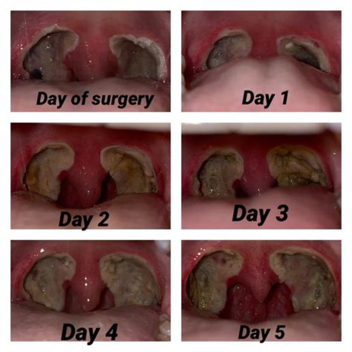 How do you drink water after a tonsillectomy?