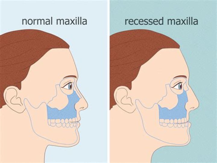 How do you fix a recessed jaw?