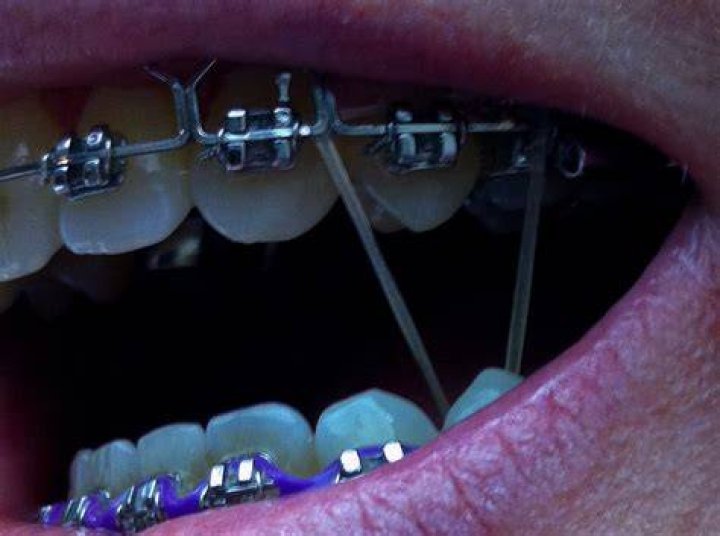 How fast do rubber bands move teeth?