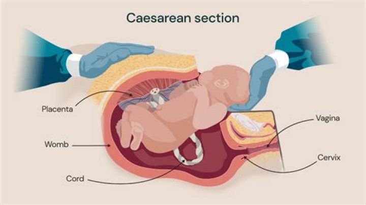 How long after C-section can u drive?