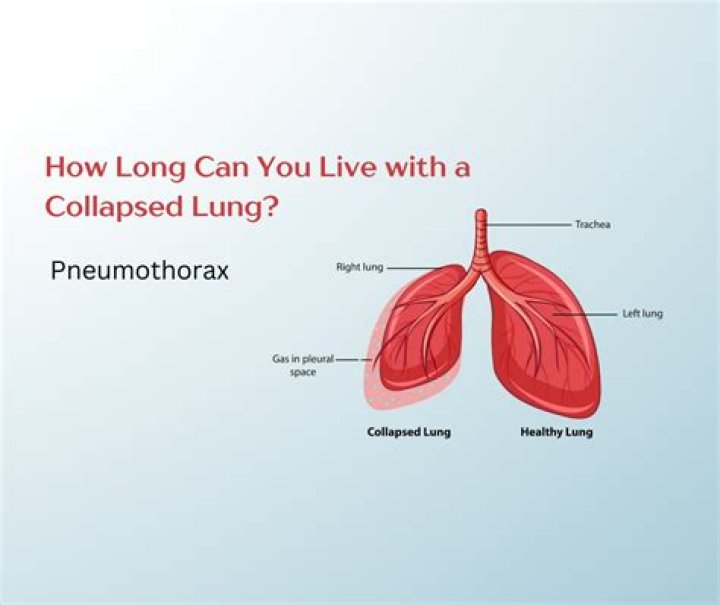 How long can you live with chordoma?