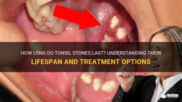 How long do tonsil stones last?
