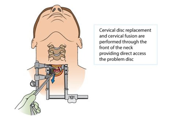 How long does pain last after partial glossectomy?