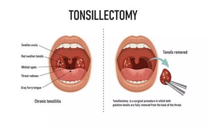 How long will ears hurt after tonsillectomy?