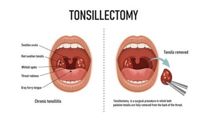 How painful is tonsil removal?