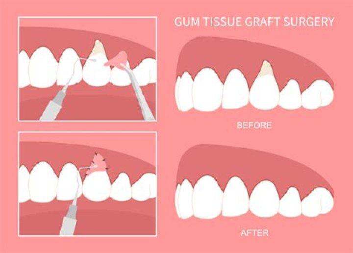 Is a stent necessary after gum graft?
