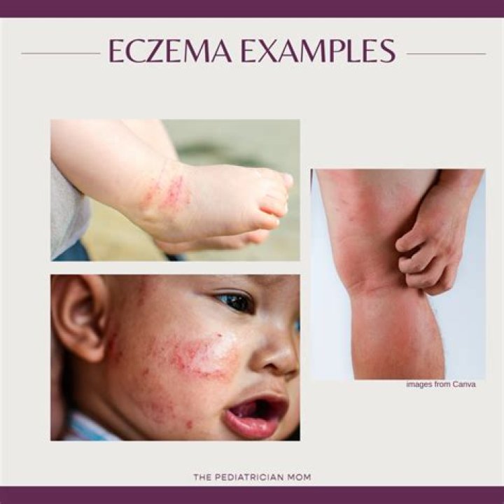 Is eczema a mental thing?