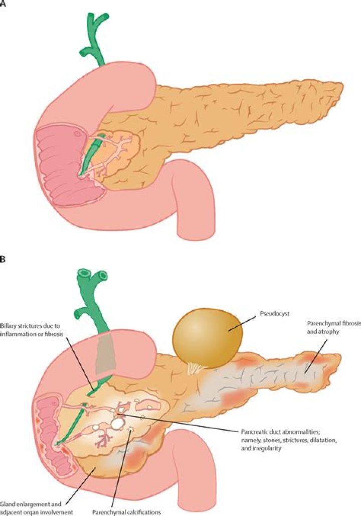 Is pancreatitis easy to diagnose?