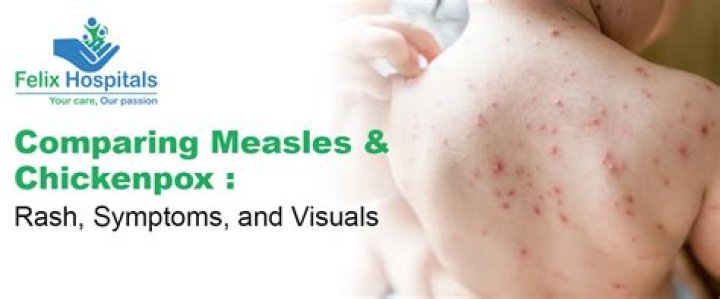 Is smallpox worse than chicken pox?