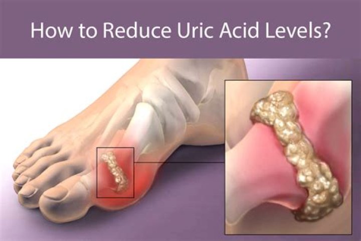 Is uric acid curable?