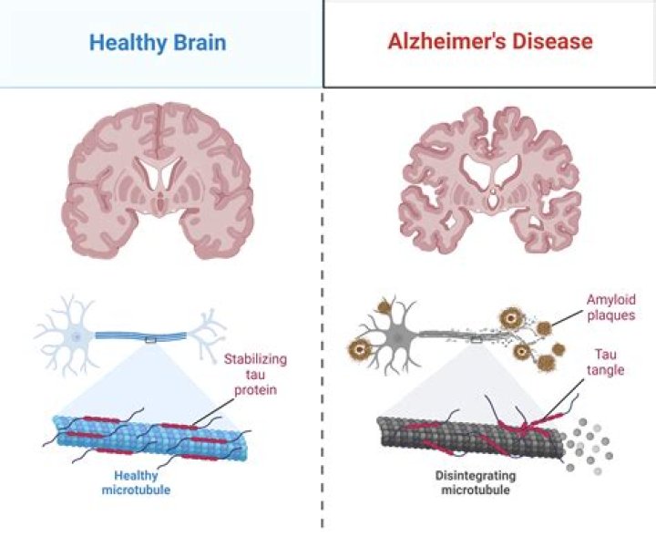 What blood type is more likely to get Alzheimer's?