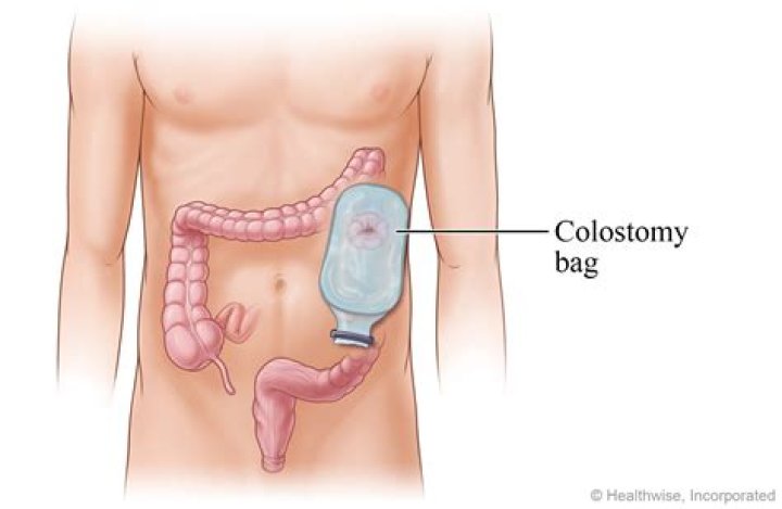 What can't you do with a colostomy bag?