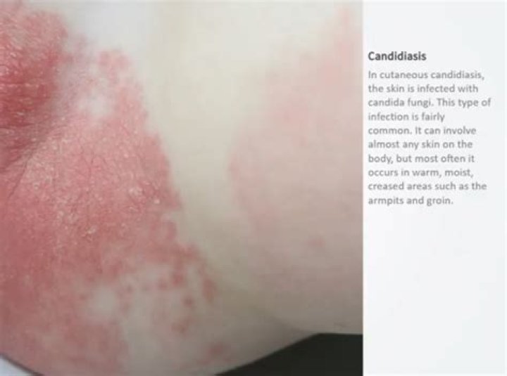 What does a Candida rash look like?