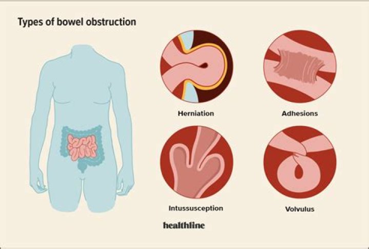 What does a stoma blockage feel like?