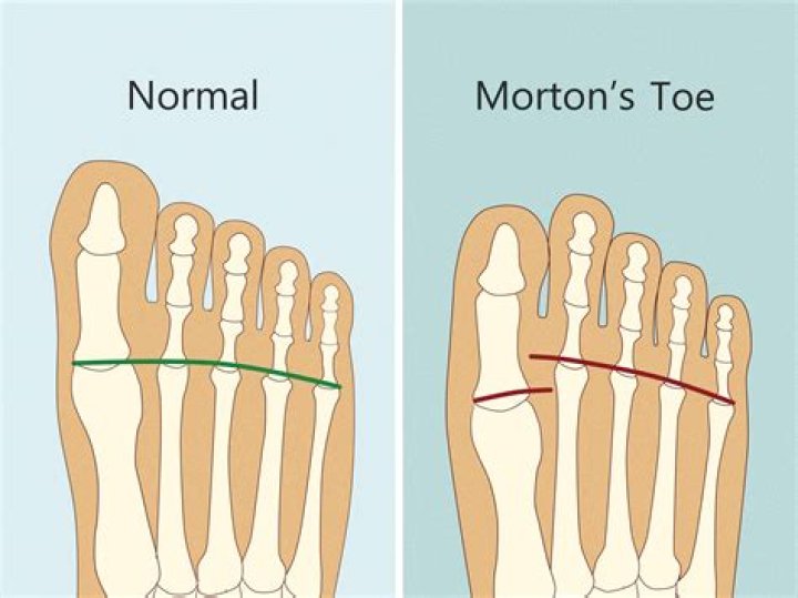What does it mean if your big toe and second toe are the same length?