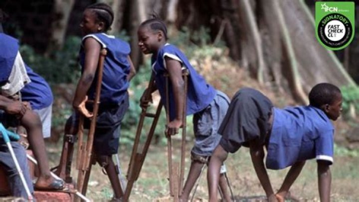 What does polio do to legs?