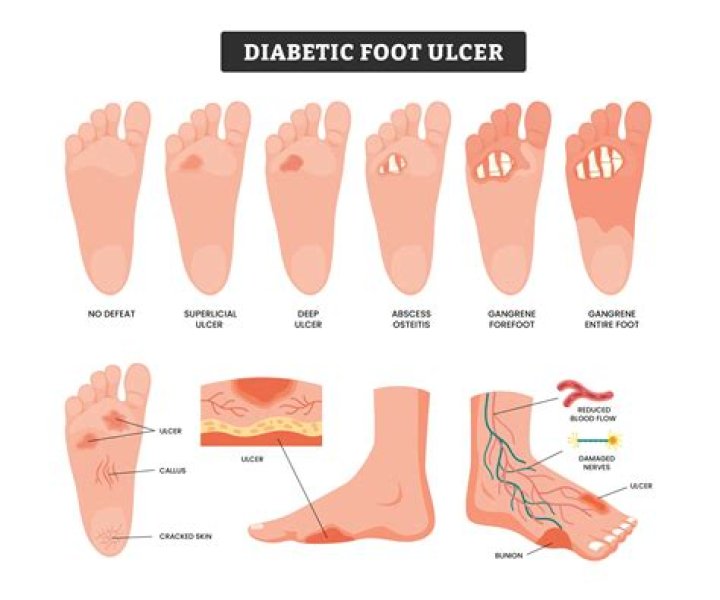 What does the beginning of an ulcer feel like?