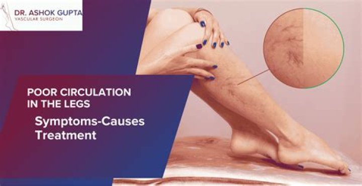 What kind of doctor treats poor circulation in legs?