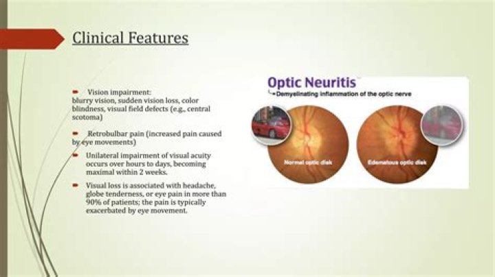 What optic neuritis looks like?