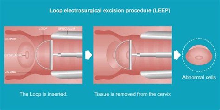 What should I do before a LEEP procedure?