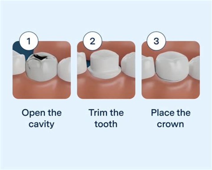What to avoid after getting a crown?