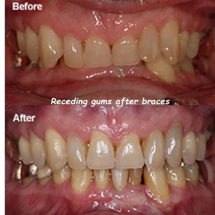 Why are my gums swollen after a crown?