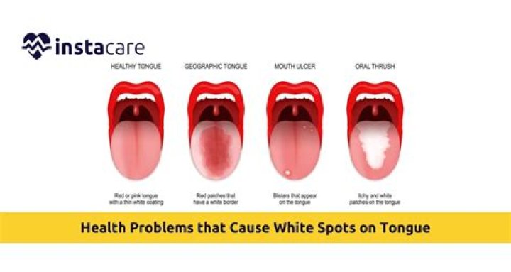 Why do I have a white bump on my tongue?