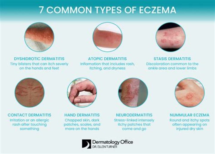 Why does my eczema sting when I put cream on it?