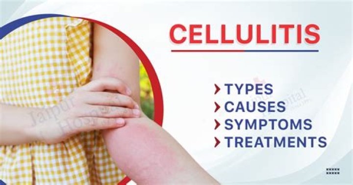 Why is my cellulite worse some days?